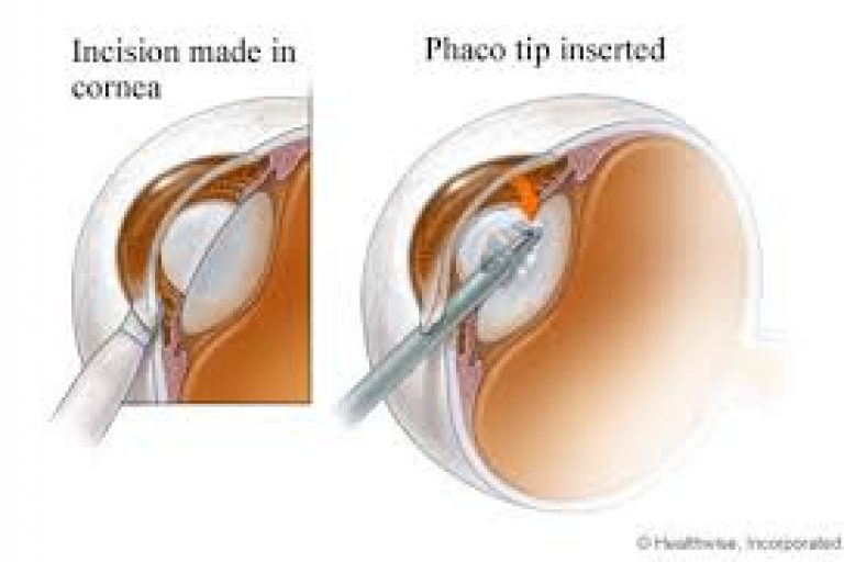 cataract