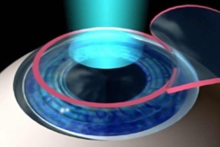 cirurgia_refrativa