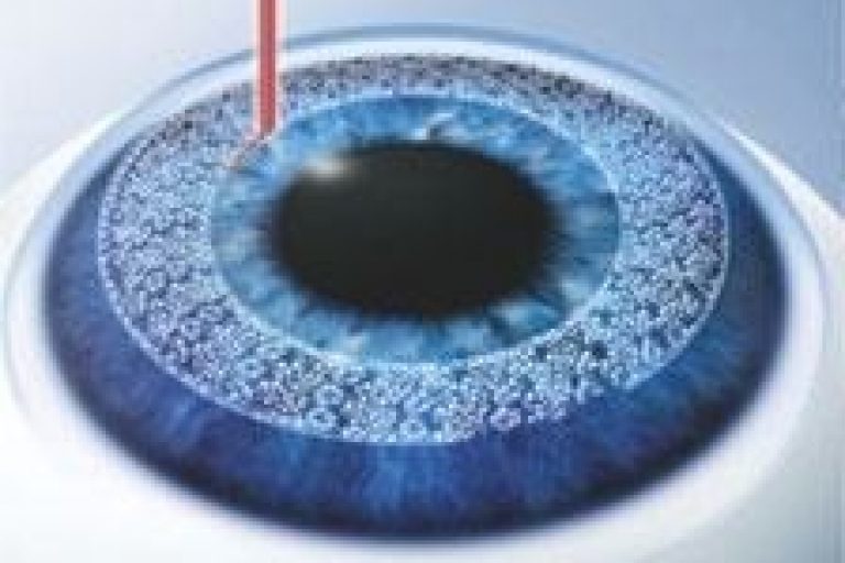 femto LASIK icon