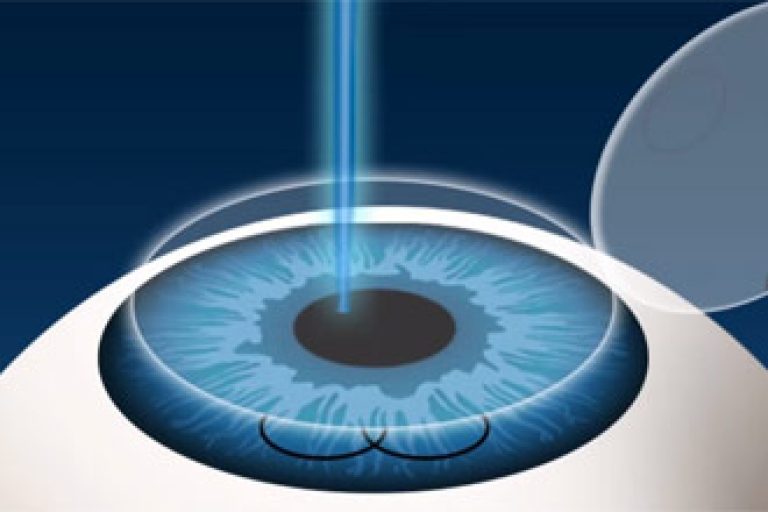 LASIK