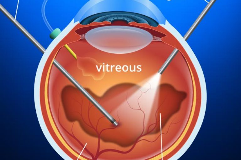 vitrectomy-330x360@2x