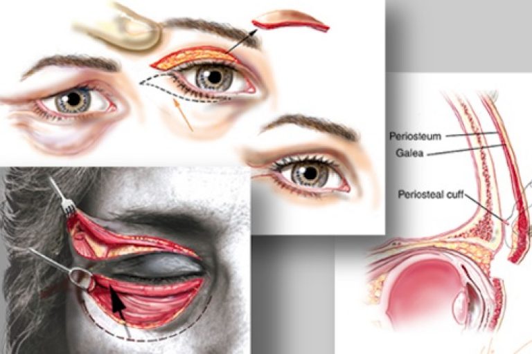 Eyelid Surgery