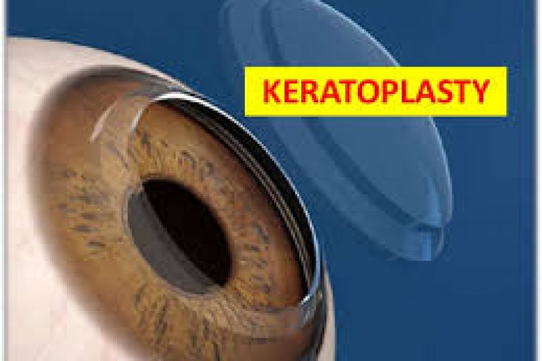 Keratoplasty