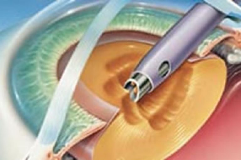 Phacoemulsification1