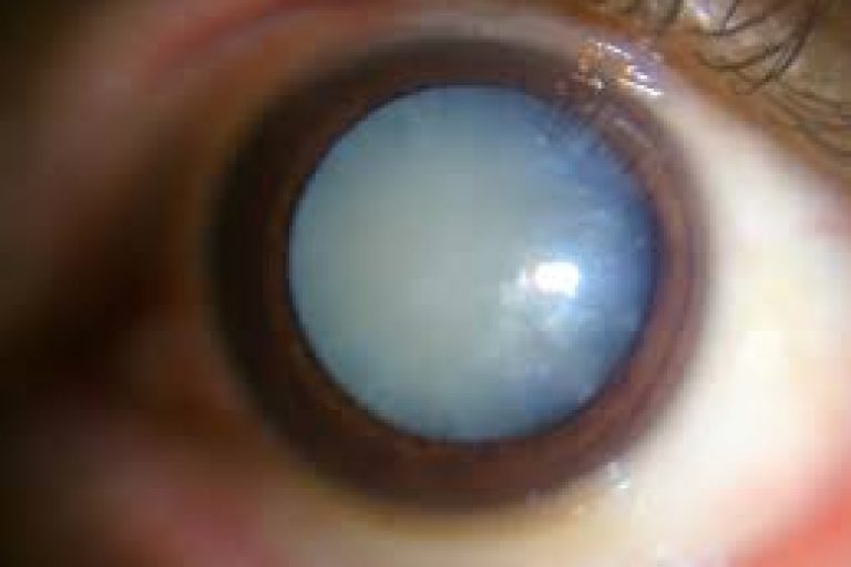 cataract 02