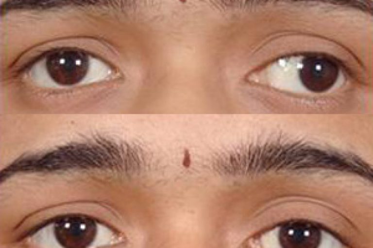 squint_eye_2